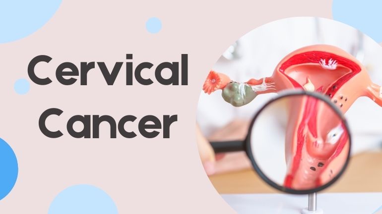 Cervical Cancer