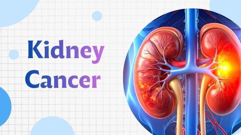 Kidney Cancer