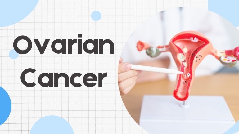 Ovarian Cancer