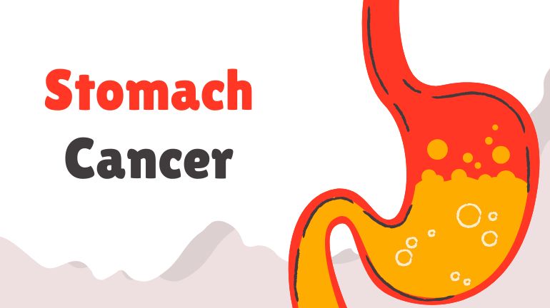 Stomach Cancer