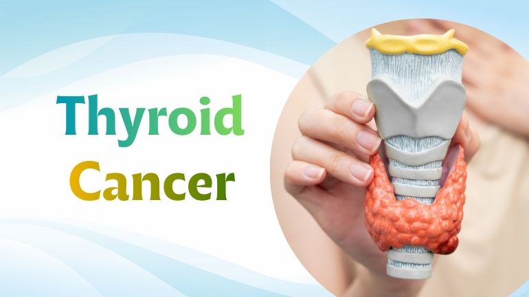 Thyroid Cancer