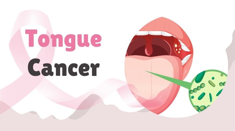 Tongue Cancer