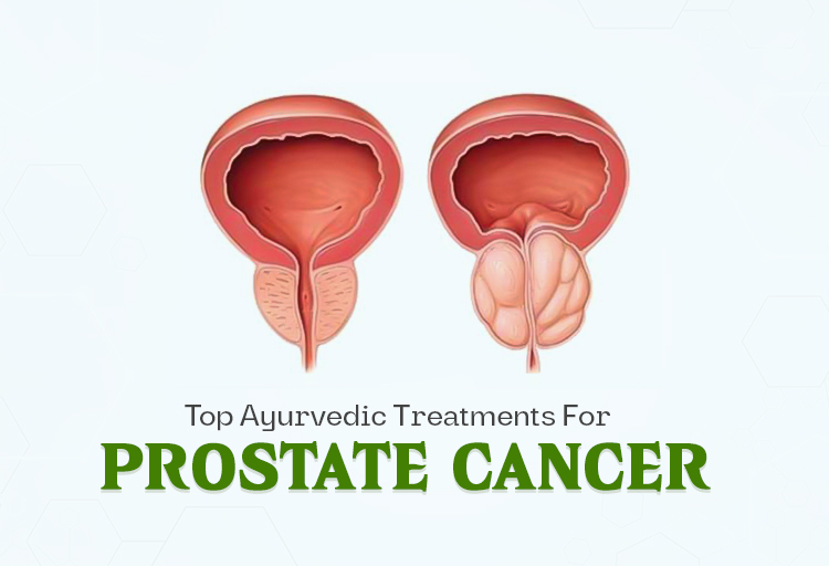 ayurvedic-treatment-for-prostate-cancer
