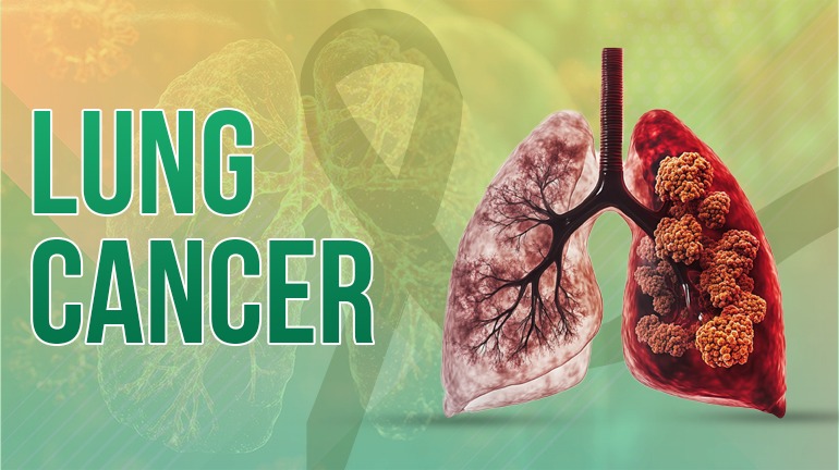 Lung Cancer
